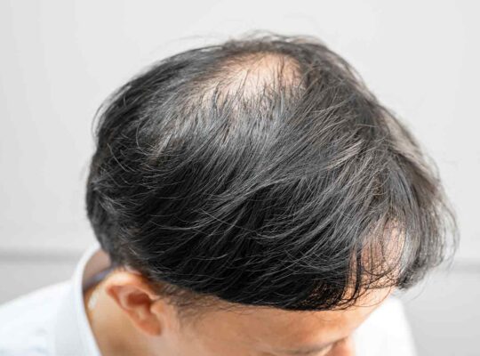 Alopecia Areata