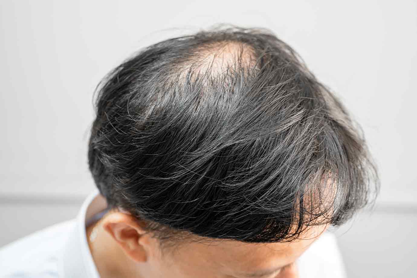 Alopecia Areata